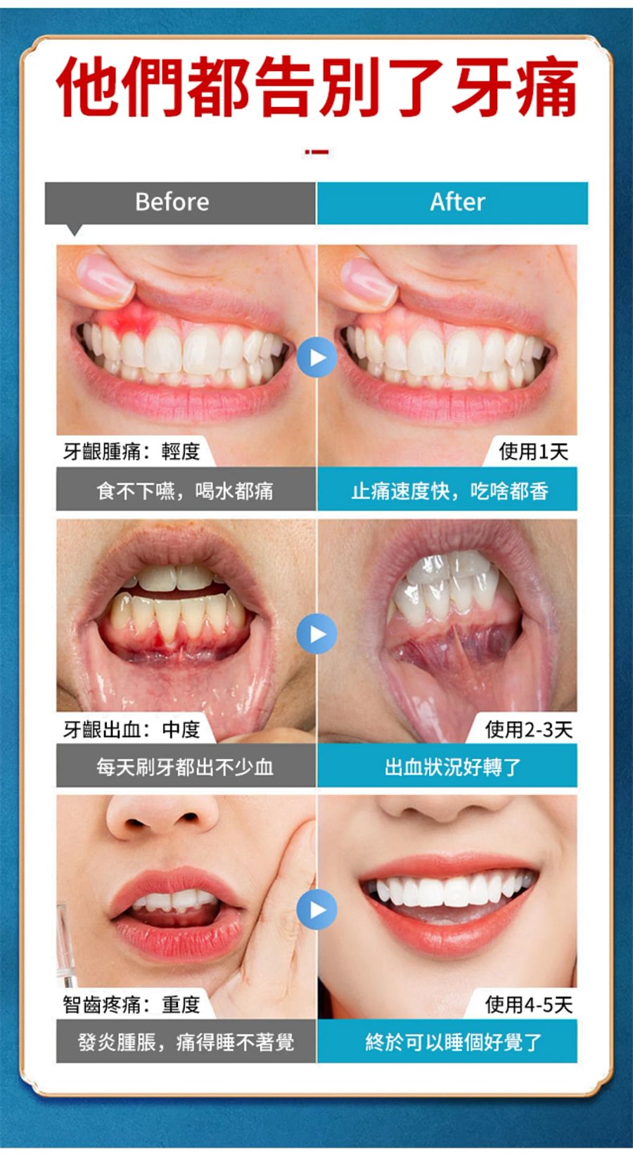 牙痛寧