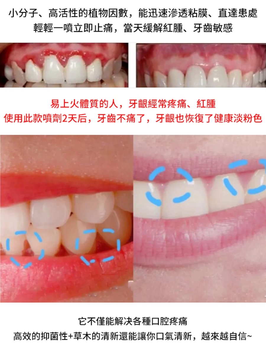 牙痛寧