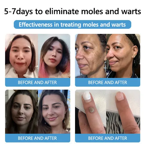 🐝🐝Bee Venom Mole and Wart Treatment Cream
