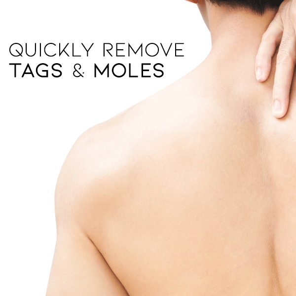 🐝🐝Bee Venom Mole and Wart Treatment Cream