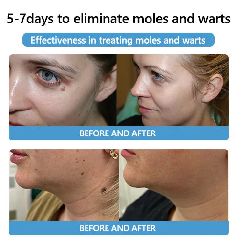 🐝🐝Bee Venom Mole and Wart Treatment Cream