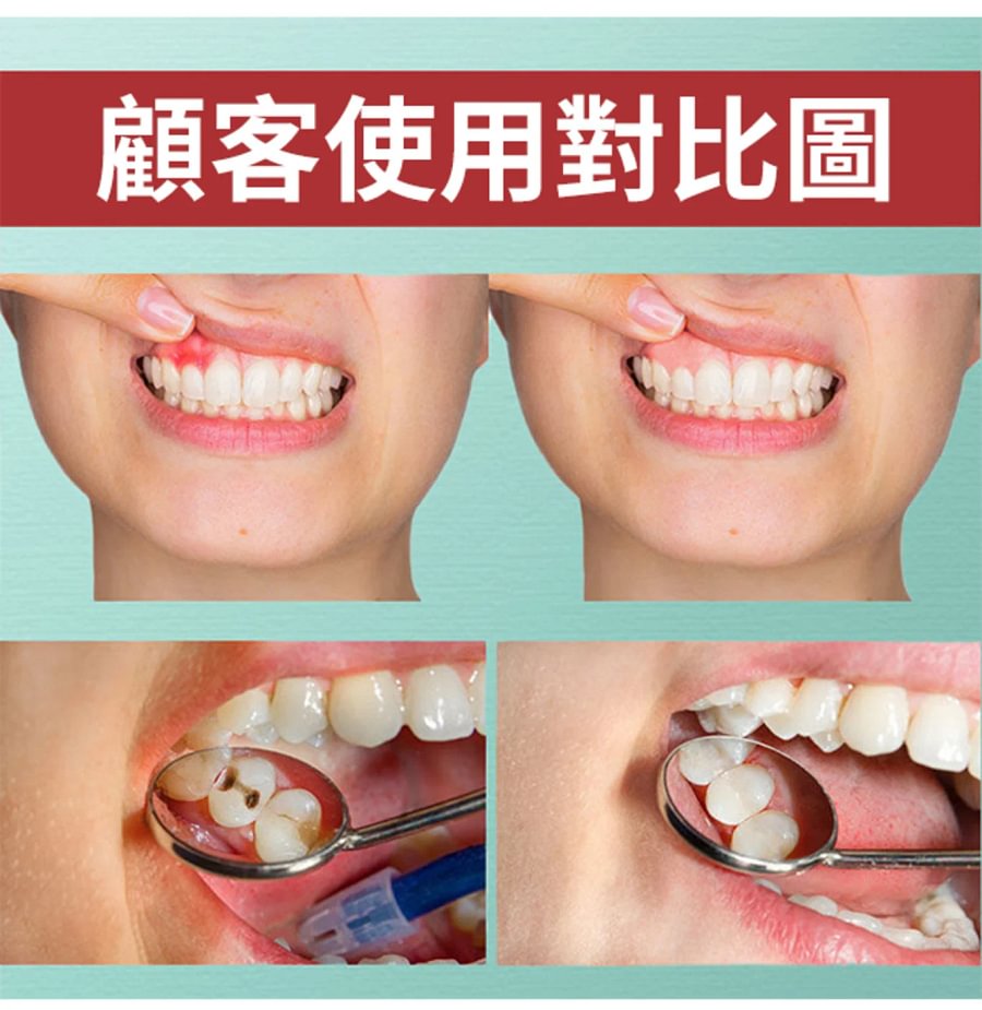 牙痛寧